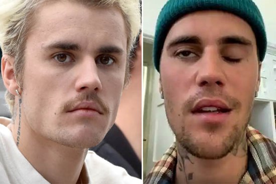 Bệnh khiến Justin Bieber liệt nửa mặt: Dấu hiệu đơn giản, có thể gây mù, điếc vĩnh viễn