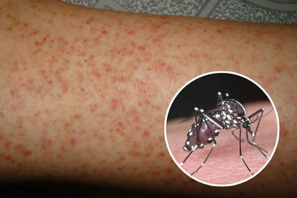 Lưu ý cần nhớ với người bệnh sốt xuất huyết khi tắm-2