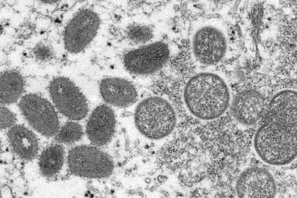 Đậu mùa khỉ: Căn bệnh khiến 66 người đã tử vong, chưa có vaccine, cần làm gì nếu nghi ngờ nhiễm bệnh?-5