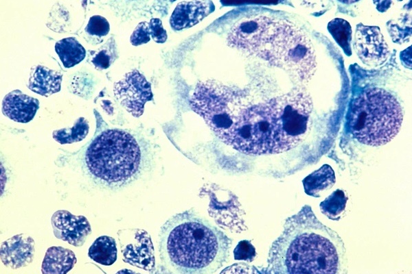 Có những dấu hiệu sau ở vùng đầu cổ mặt, cẩn thận bị loại ung thư cực kỳ nguy hiểm, gây tử vong cao-2