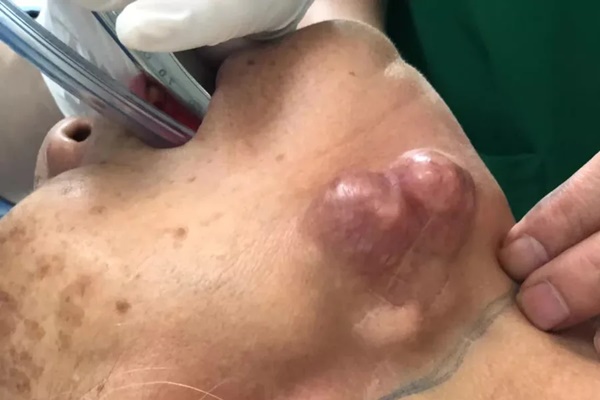 Có những dấu hiệu sau ở vùng đầu cổ mặt, cẩn thận bị loại ung thư cực kỳ nguy hiểm, gây tử vong cao-1