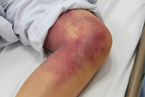 Rắn hổ bò vào nhà cắn tay người dân, cảnh báo mùa rắn cắn đang đến-2