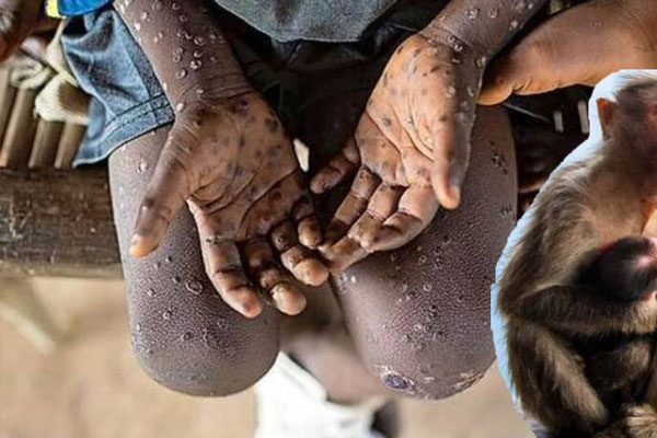 WHO xem xét tuyên bố đậu mùa khỉ là tình trạng khẩn cấp toàn cầu-3