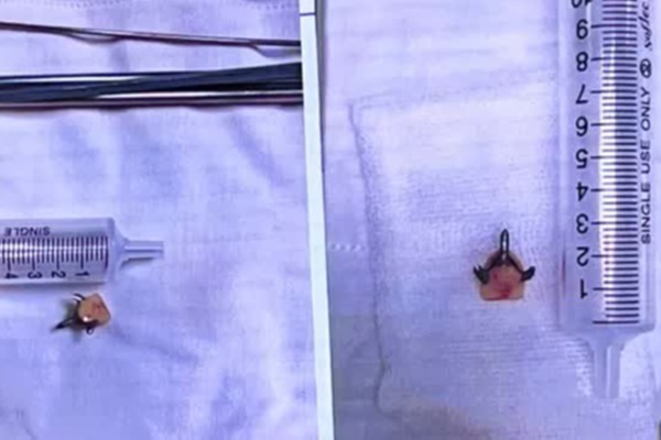 Răng giả rơi vào phế quản khiến cô gái suýt tắc thở-1