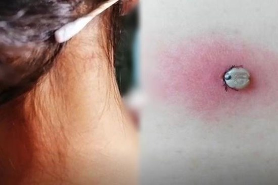 Mẹ giật mình khi phát hiện sự thật về “nốt ruồi” ở gần gáy con gái