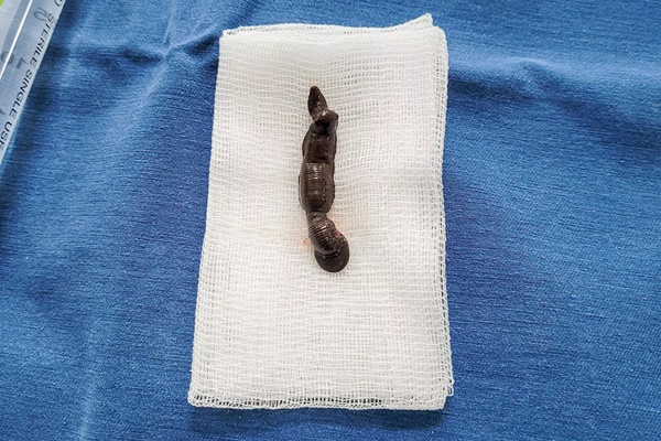 Trẻ 4 tuổi nôn ra máu kèm con đỉa sau lần tắm suối-1