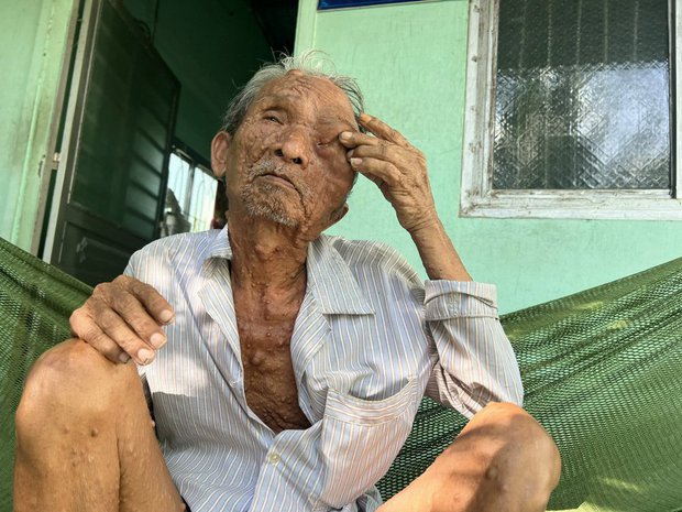 Bi kịch cuộc đời người đàn ông bị bướu che kín mặt và nỗi nhớ thương người vợ quá cố-2