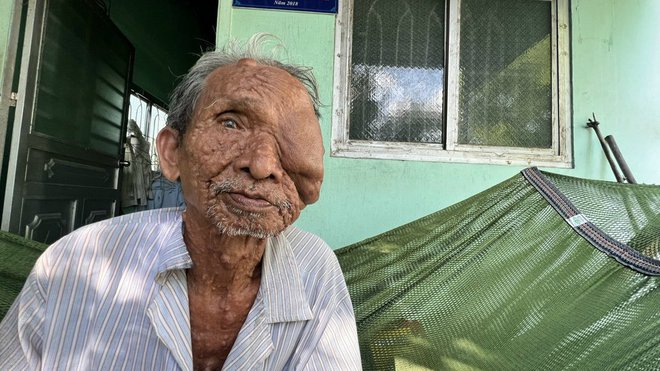 Bi kịch cuộc đời người đàn ông bị bướu che kín mặt và nỗi nhớ thương người vợ quá cố-4