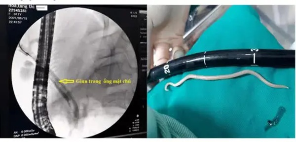 Nội soi gắp giun đũa dài gần 20cm trong ống mật chủ bé gái 11 tuổi-1