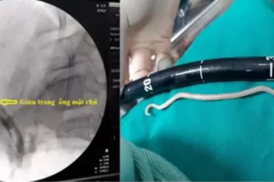 Nội soi gắp giun đũa dài gần 20cm trong ống mật chủ bé gái 11 tuổi