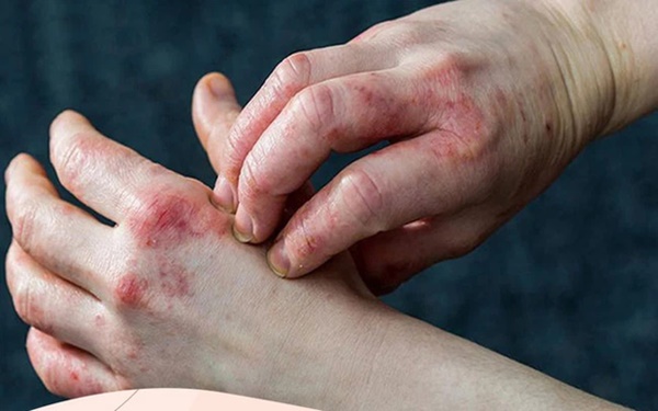 5 kiểu ngứa cho thấy bệnh tiểu đường đang ẩn nấp trong cơ thể nhưng thường bị người trẻ tuổi xem nhẹ-4