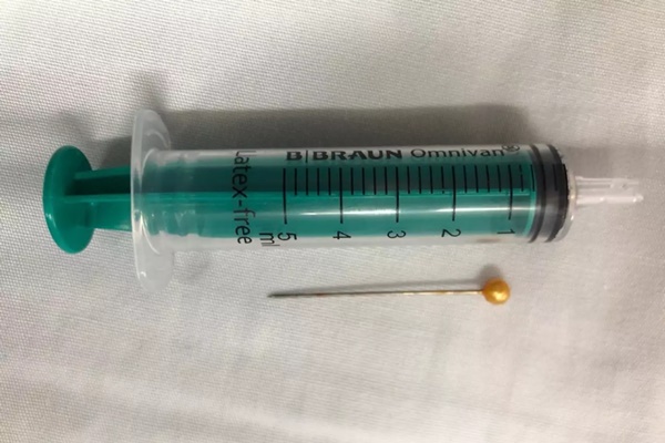 Hy hữu: Gắp một chiếc kim trong đường thở bé 10 tuổi-1