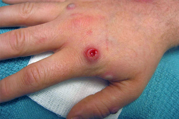 Thời gian ủ bệnh mới của người mắc đậu mùa khỉ-1