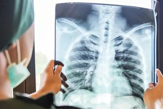 Triệu chứng ung thư phổi bộc lộ trên mặt hay bị bỏ qua