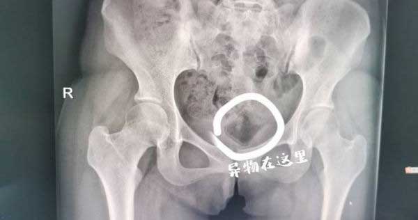 Cặp đôi tìm cảm giác lạ lúc mây mưa, bạn trai gây tai nạn cho bạn gái vì dị vật lạ-1