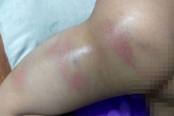 Công an vào cuộc vụ bé gái 4 tuổi bị cô giáo đánh bầm tím người-3