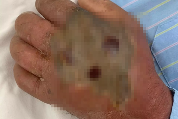 Suy đa tạng, hoại tử tay vì tự chữa rắn hổ mang cắn theo kinh nghiệm dân gian-1