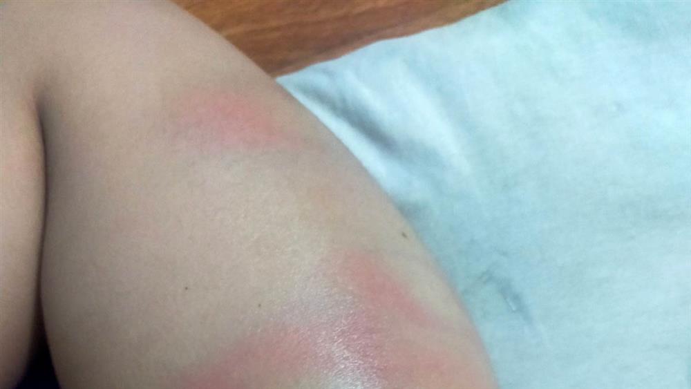 Công an vào cuộc vụ bé gái 4 tuổi bị cô giáo đánh bầm tím người-2