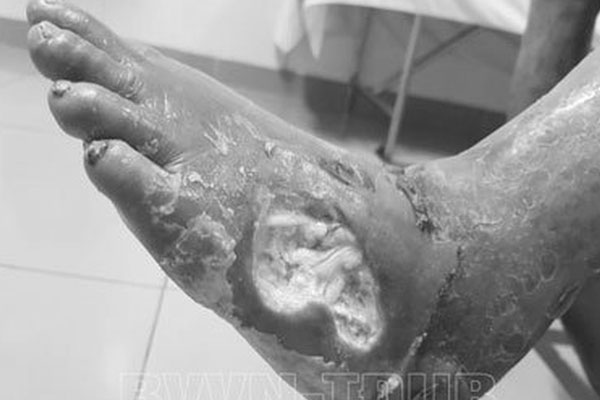 Người bệnh đái tháo đường bị nhiễm trùng, hoại tử bàn chân do tự ý dùng thuốc-1