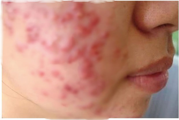 Mặt chi chít mụn sau dùng kem dưỡng ẩm mùa hè, bác sĩ chỉ ra sai lầm nhiều bạn gái trẻ mắc phải-1