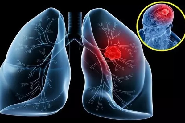 5 dấu hiệu cảnh báo ung thư sớm không được bỏ qua-3