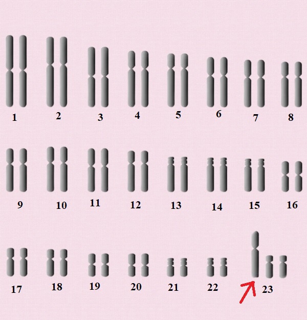 Hội chứng siêu nam XYY có thể khiến trẻ cao bất thường, nói ngọng và chậm phát triển trí tuệ? Dấu hiệu để nhận biết và cách chữa trị?-1