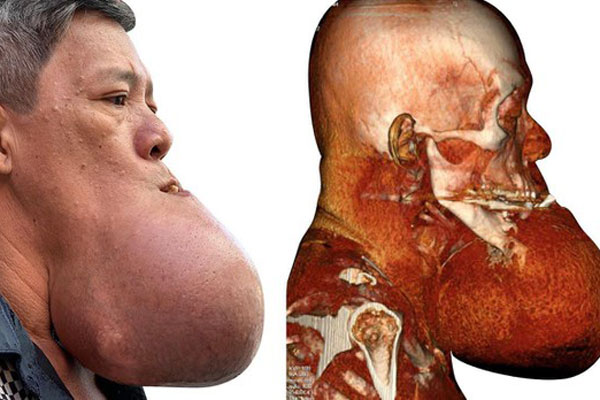 Cô bé gần 2 tuổi hết sạch 100 khối u khiến bác sĩ cũng ngỡ ngàng-2