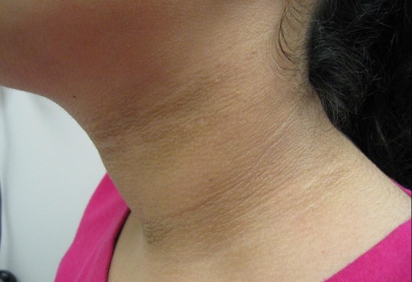 Nếu có ung thư trong cơ thể, 5 bộ phận này sẽ chuyển sang màu đen nhưng tiếc rằng ít ai để ý-4