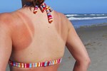 Cách chữa làn da bị cháy nắng hiệu quả nhất tại nhà
