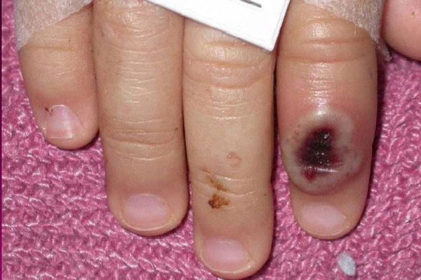 Virus đậu mùa khỉ lây lan, WHO sắp họp khẩn-1