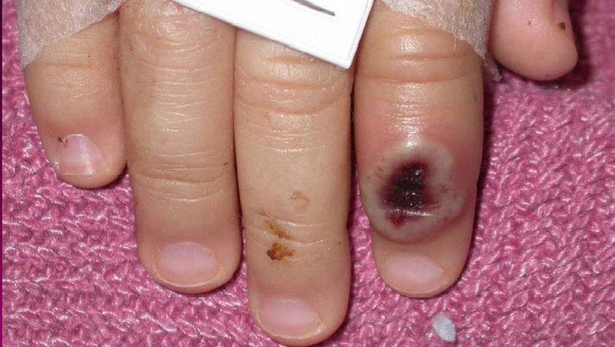 Phát hiện bệnh nhi nhiễm đậu mùa khỉ đầu tiên trên thế giới-1