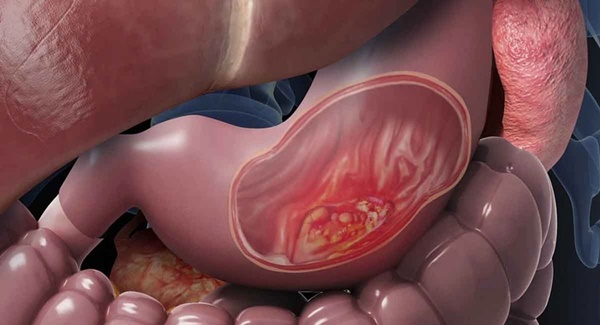 Những bệnh ung thư có thể mắc do tiêu thụ thực phẩm bẩn-2