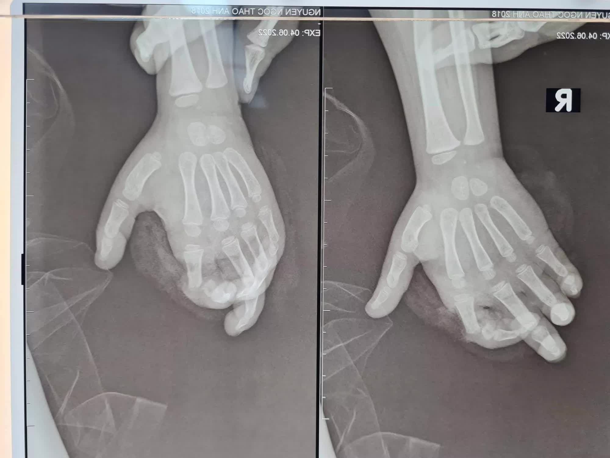 Máy xay sinh tố nghiền nát ngón tay bé gái ở Hà Nội-1