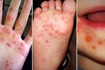 Trẻ có thể bị tay chân miệng và sốt xuất huyết cùng lúc không? Phân biệt vết loét do tay chân miệng gây ra-3