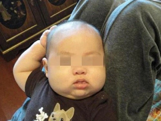 Bé trai 2 tuổi thường xuyên gãi đầu, đến bệnh viện, bác sĩ nói may mà phát hiện sớm-1