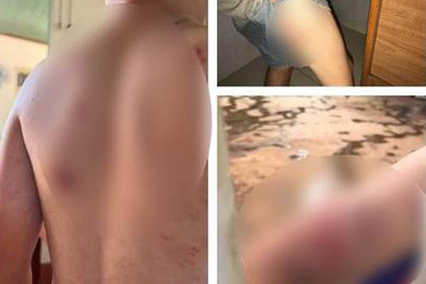 Vụ cháu bé 9 tuổi bị đánh đập dã man: Phát hiện xương bàn tay bị gãy-3