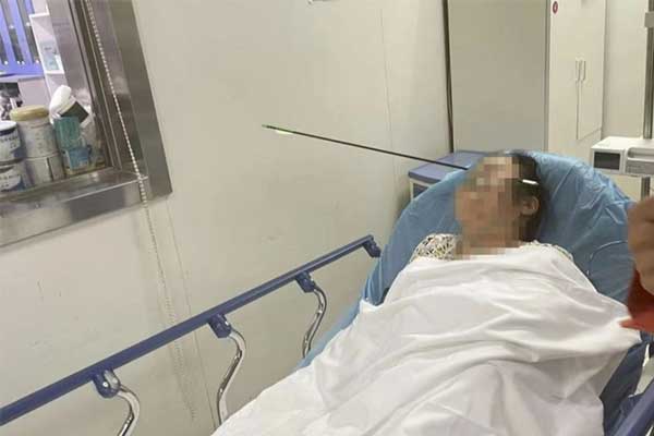 Đang đi bộ, người phụ nữ bị cung tên bắn xuyên qua mặt-1