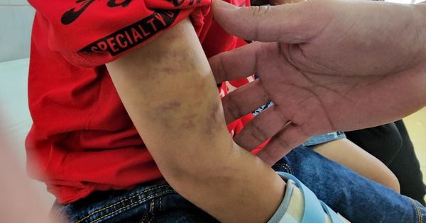 Vụ cháu bé 9 tuổi bị đánh đập dã man: Phát hiện xương bàn tay bị gãy-1