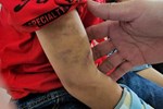 Vụ cháu bé 9 tuổi bị đánh đập dã man: Phát hiện xương bàn tay bị gãy