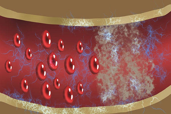 Mạch máu có bị tắc nghẽn hay không chỉ cần đi bộ 3 bước là biết, nếu có 3 dấu hiệu này ở chân thì cần đi khám càng sớm càng tốt-3