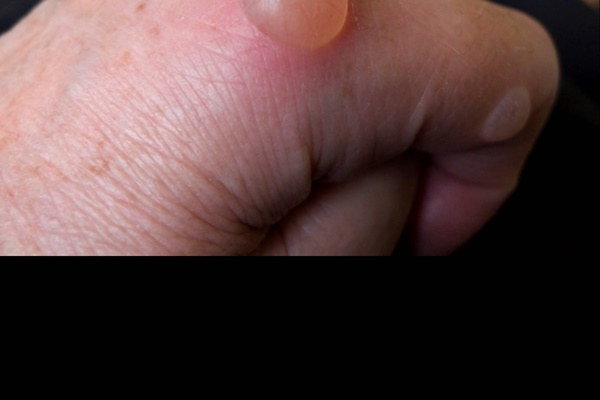 10 dấu hiệu trên da cảnh báo bệnh tiểu đường-4