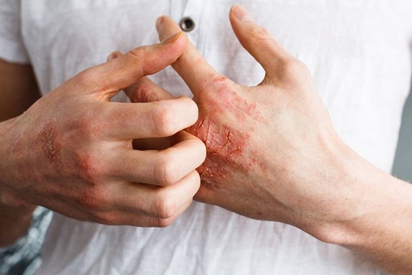 10 dấu hiệu trên da cảnh báo bệnh tiểu đường-5