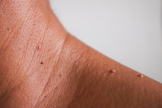 10 dấu hiệu trên da cảnh báo bệnh tiểu đường