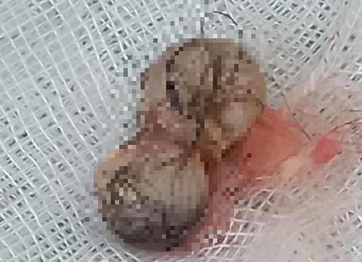 Nữ bệnh nhân 22 tuổi bị viêm não tự miễn nguy kịch-2