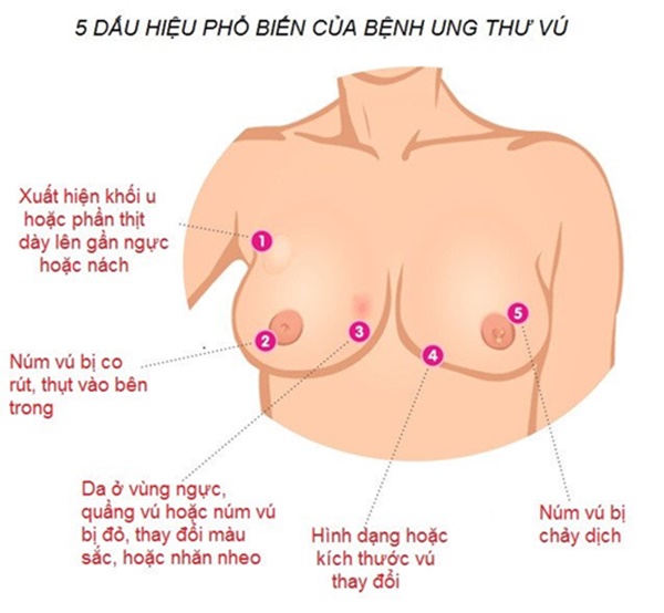 Nữ ca sĩ xinh đẹp qua đời ở tuổi 41 do mắc cùng căn bệnh giống mẹ, chuyên gia chỉ rõ khả năng di truyền cao-2