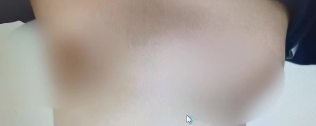 Ngực cậu bé 11 tuổi phát triển như ngực bé gái, cha mẹ đừng chủ quan với căn bệnh này-1