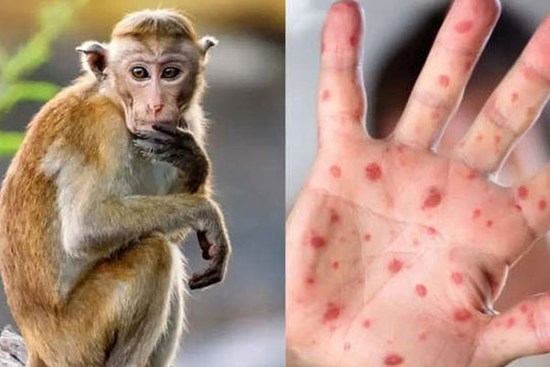 Virus đậu mùa khỉ lây lan, WHO sắp họp khẩn