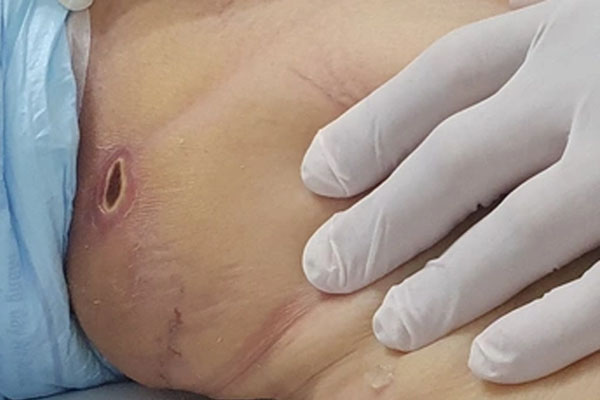 Vết thương nhỏ trên da cảnh báo bệnh nguy hiểm-2