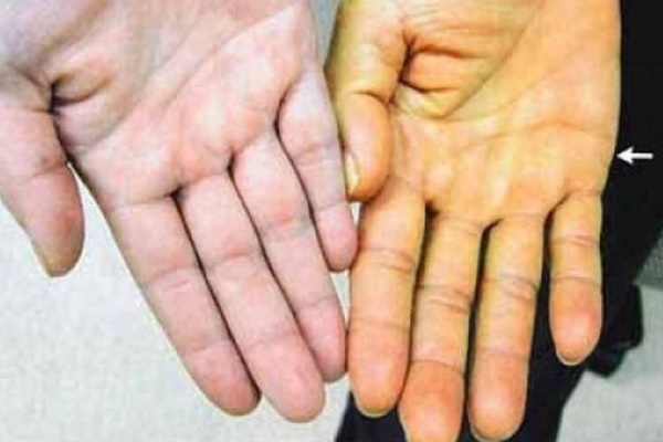 Thiếu nữ 18 tuổi tử vong do sốt xuất huyết ở Đồng Nai-2