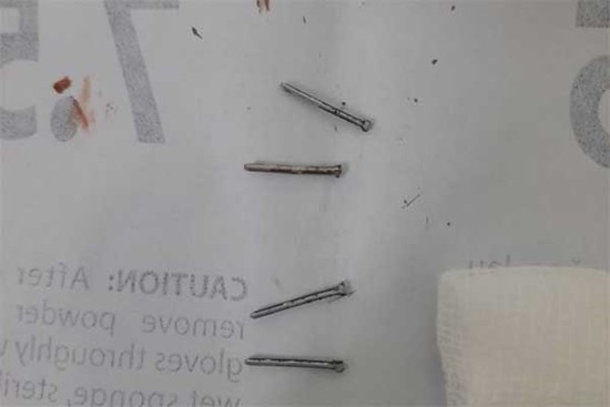 Tây Ninh: Người đàn ông tự đóng đinh vào đầu để... giải sầu